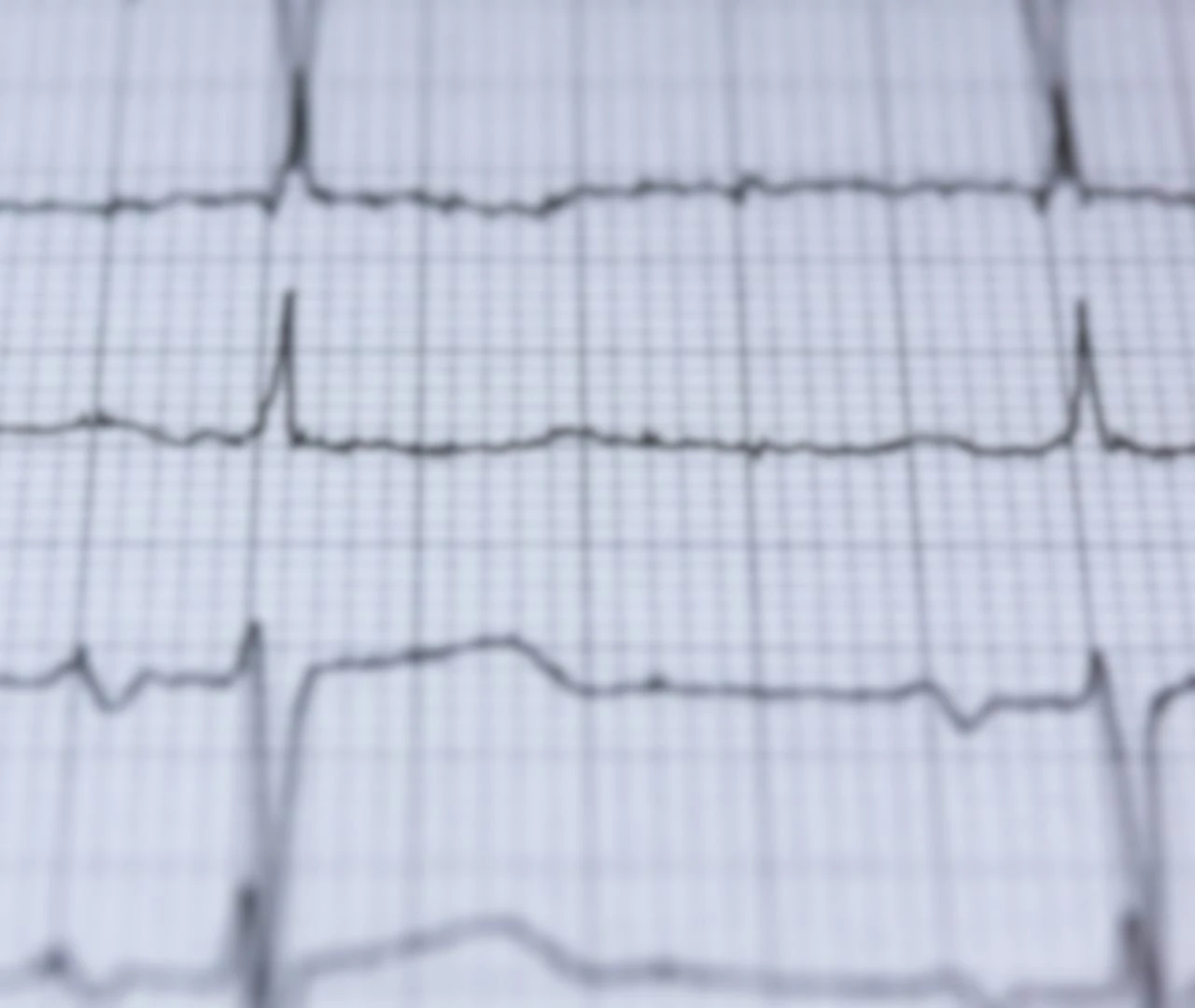 Electrocardiograma de 12 Derivaciones