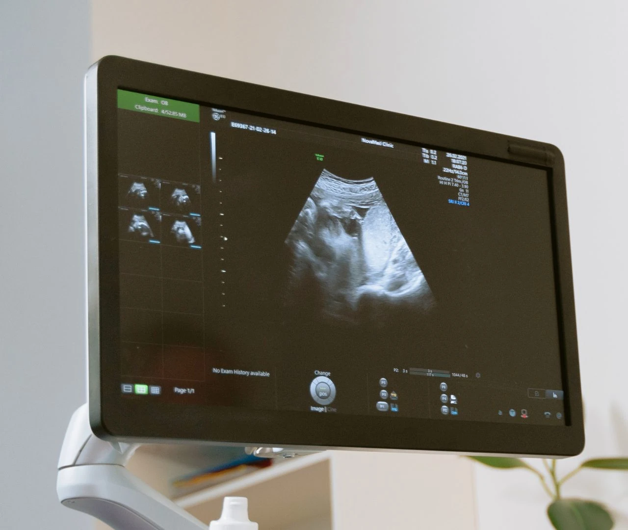 Ultrasonido de Próstata (con medición de orina residual)